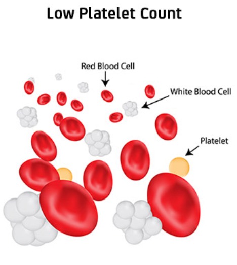 thrombocytopenia-in-pregnancy